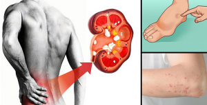 10 Tanda Anda Mungkin Memiliki Penyakit Ginjal