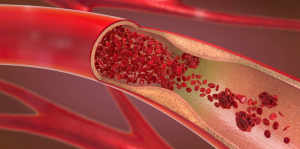 Pembekuan Darah: Gejala Yang Harus Diwaspadai dan Kapan Harus Menghubungi Dokter