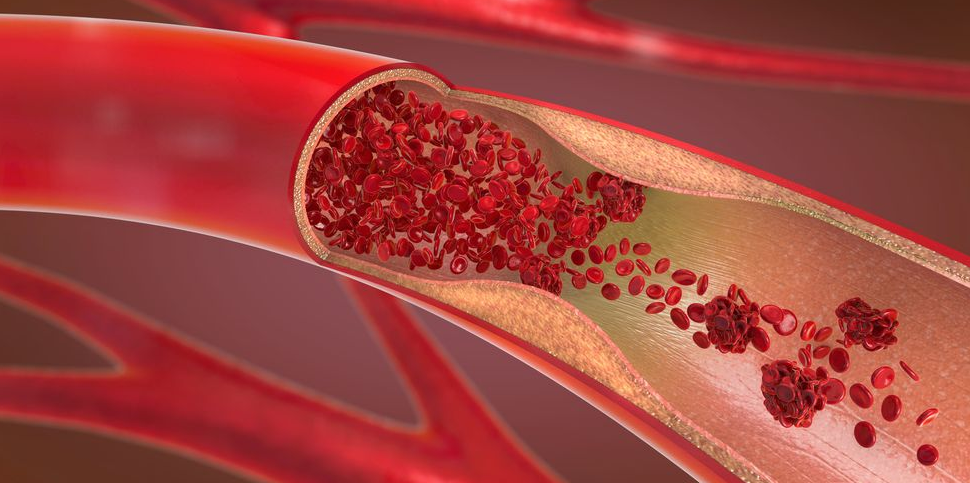 Pembekuan Darah: Gejala Yang Harus Diwaspadai dan Kapan Harus Menghubungi Dokter