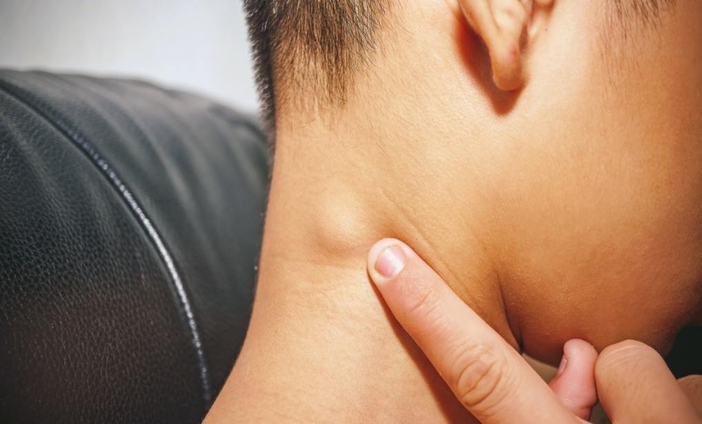 Pembengkakan Kelenjar Getah Bening