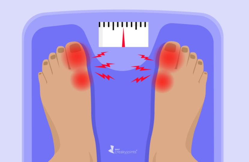 Kenaikan Berat Badan di Masa Dewasa Berisiko Lebih Besar Terkena Asam Urat