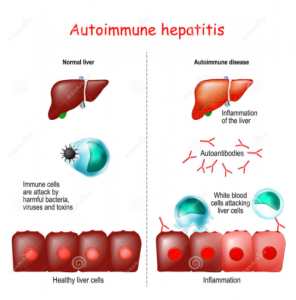 Autoimmune Hepatitis
