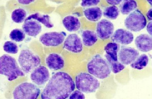 Leukemia Limfositik Akut