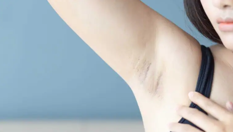 Apakah Ketiak Anda Semakin Gelap di Musim Panas?