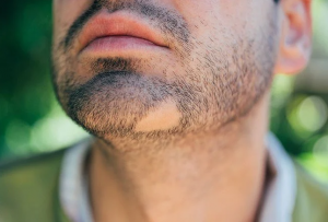 Alopecia Areata: Bagaimana Cara Mengobatinya dan Bisakah Disembuhkan?