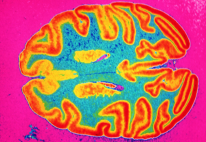 Coronavirus: Bahkan COVID-19 Ringan Dapat Mengecilkan Otak Anda Setara Dengan Penuaan 10 Tahun