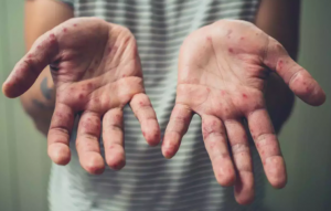 Mengapa Monkeypox disebut Monkeypox; Kasus Virus Meningkat