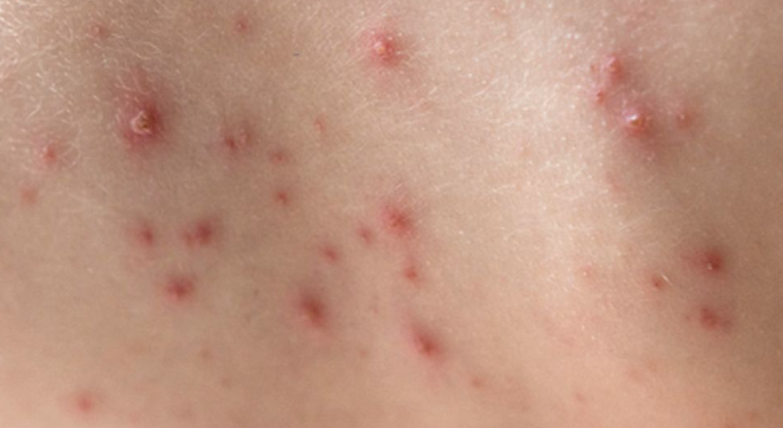 Bagaimana ruam COVID-19 berbeda dari ruam Monkeypox