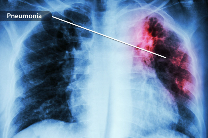 Seperti Apa Penampakan Pneumonia COVID, Kenali Gejala Dasarnya