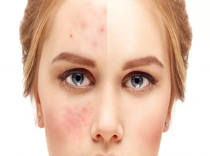 Beginilah cara mikrobioma membantu membalikkan kerusakan kulit