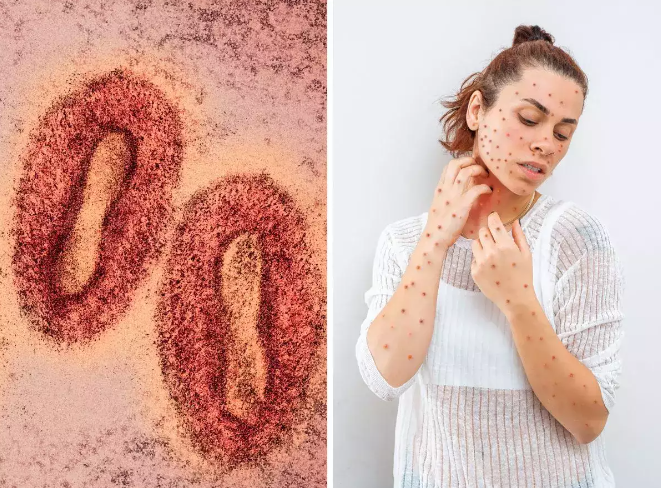 Cara Mengetahui Ruam Kulit atau Lesi di Tubuh Anda Bukan Cacar Monyet