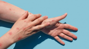 Apakah cacar monyet menyebabkan masalah jantung?