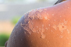 Efek Berbahaya dari Paparan Sinar Matahari Berlebihan