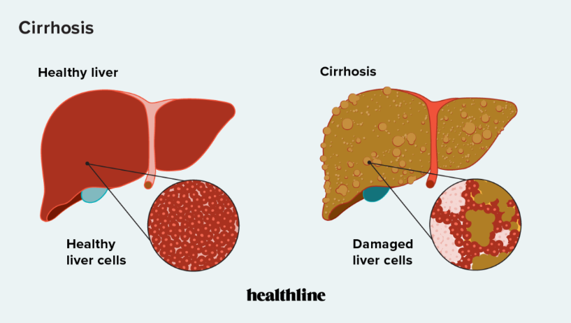 Tanda Peringatan Penyakit Liver Sirosis