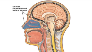Gejala, Penyebab dan Cara Mengobati Penyakit Sinusitis