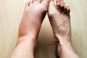 Pembengkakan Di Kaki Bagian Bawah Bisa Menjadi Tanda Gejala Penyakit Jantung
