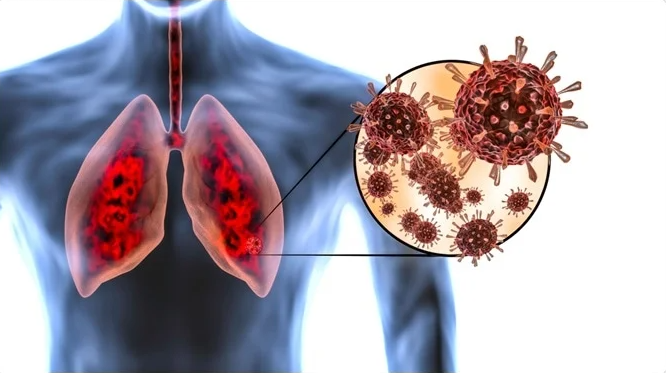 Tanda Paru-paru Anda Belum Sepenuhnya Pulih Dari COVID