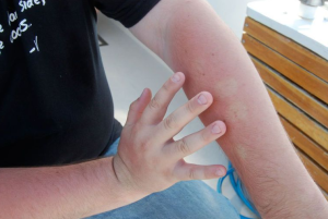 Caranya Mengatasi Kulit Melepuh Dan Mengelupas Akibat Terbakar Sinar Matahari