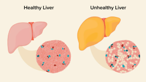Penyakit Hati Berlemak Dan Jenisnya