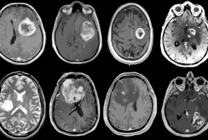 Jenis Tumor Otak Berdasarkan Tingkat Keganasannya