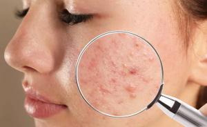 Cara Mencegah dan Mengobati Bekas Jerawat