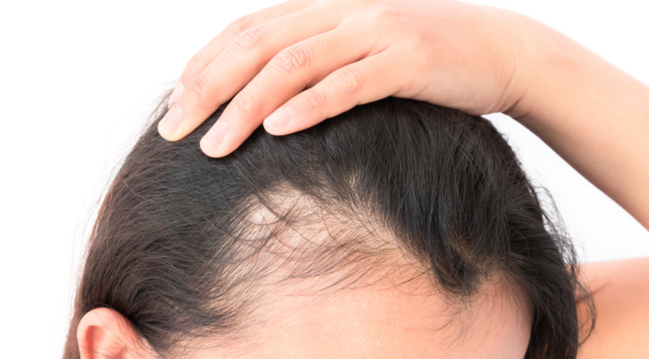 Penyebab Rambut Rontok saat Berat Badan Turun